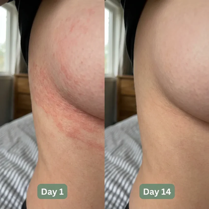 💚 LAST DAY BUY 1 GET 1 FREE✨Intertrigo Relief Cream treats 99% of skin fold rashes from the first application SevoreaTMIntertrigo Cream🛒
