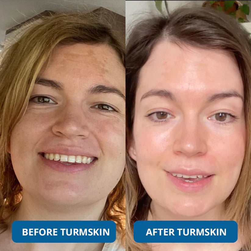 🔥3% Hyaluronic Acid Ultra Hydrating Serum by TurmSkin🔥