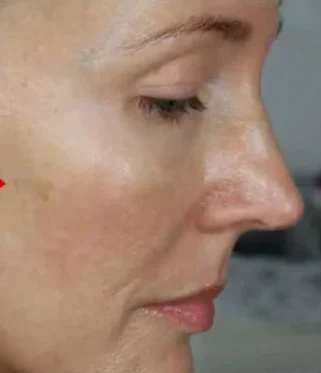 🔥【🎁2025 New Year Hot Sale🎁】5PAIRS INSTANT BEAUTY FACE NUTRITION WRINKLE REMOVAL LIFT STICKER