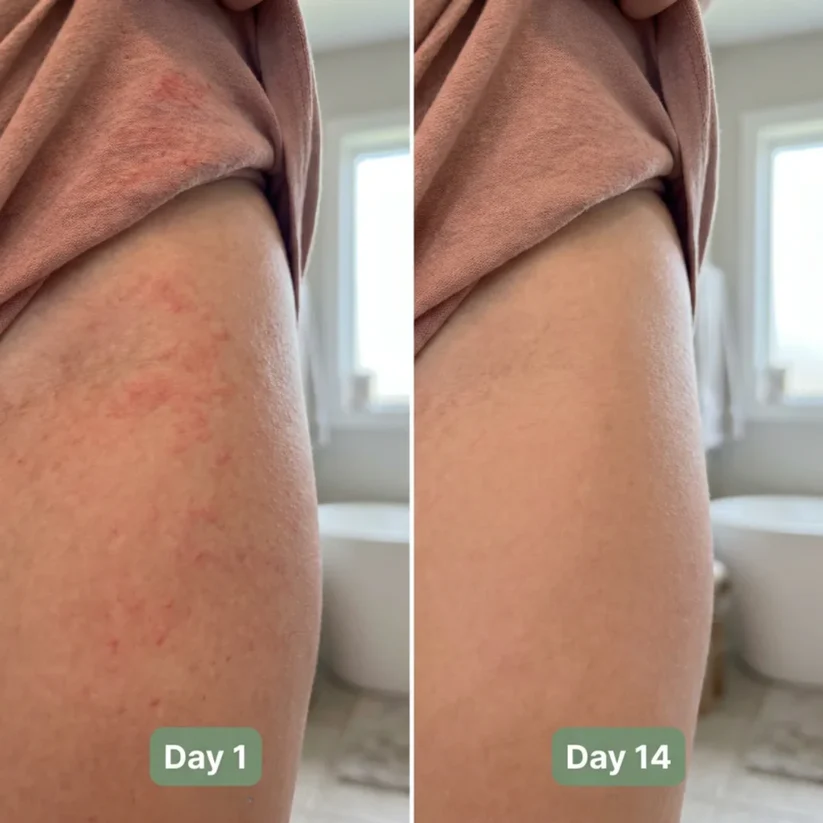 💚 LAST DAY BUY 1 GET 1 FREE✨Intertrigo Relief Cream treats 99% of skin fold rashes from the first application SevoreaTMIntertrigo Cream🛒